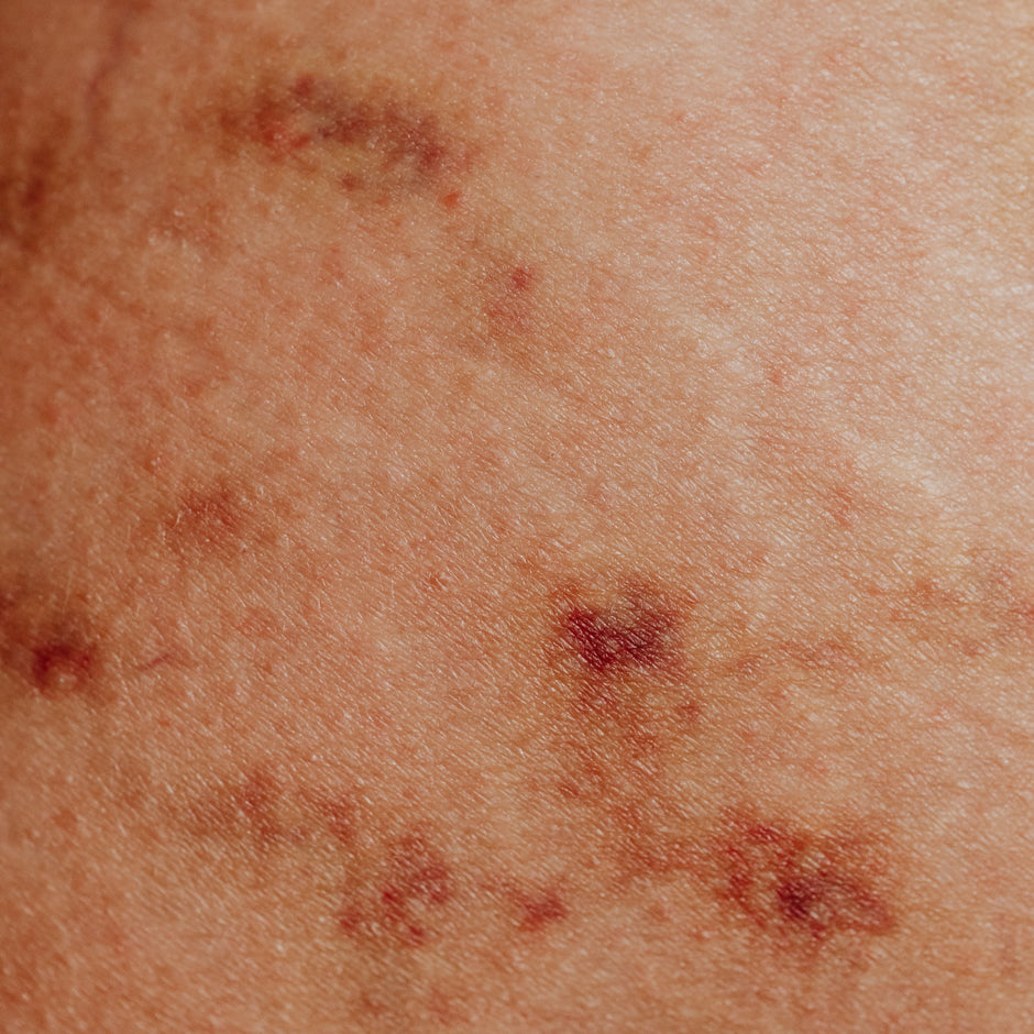 Butt Rash: 7 Common Causes and How to Tell Them Apart
